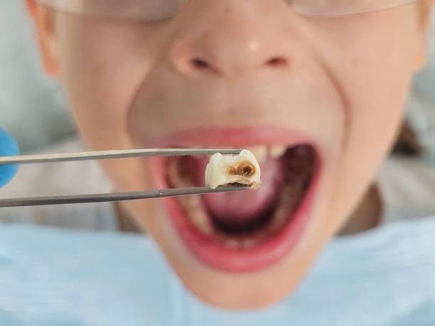 Best Root Canal Emergency Dentist  in Prichard, AL